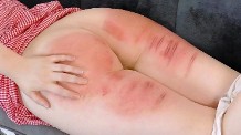 Sore welted buttocks and thighs